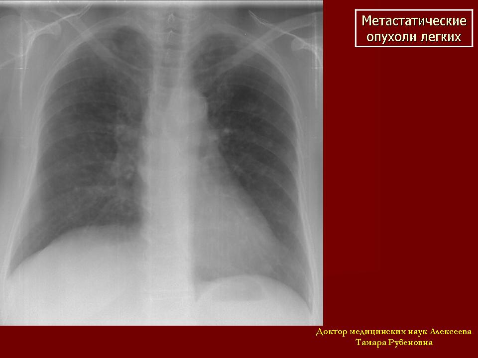 Опухоль легких. Метастатическое поражение легких. Новообразование легкого. Новообразование в легких. Метастатические опухоли легких.