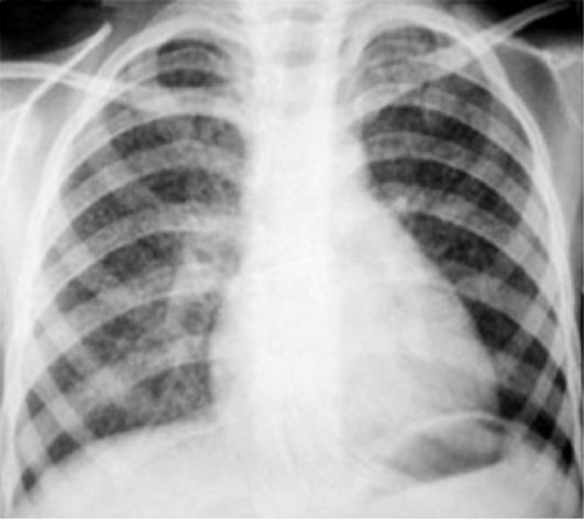 стадии, виды и формы туберкулеза легких